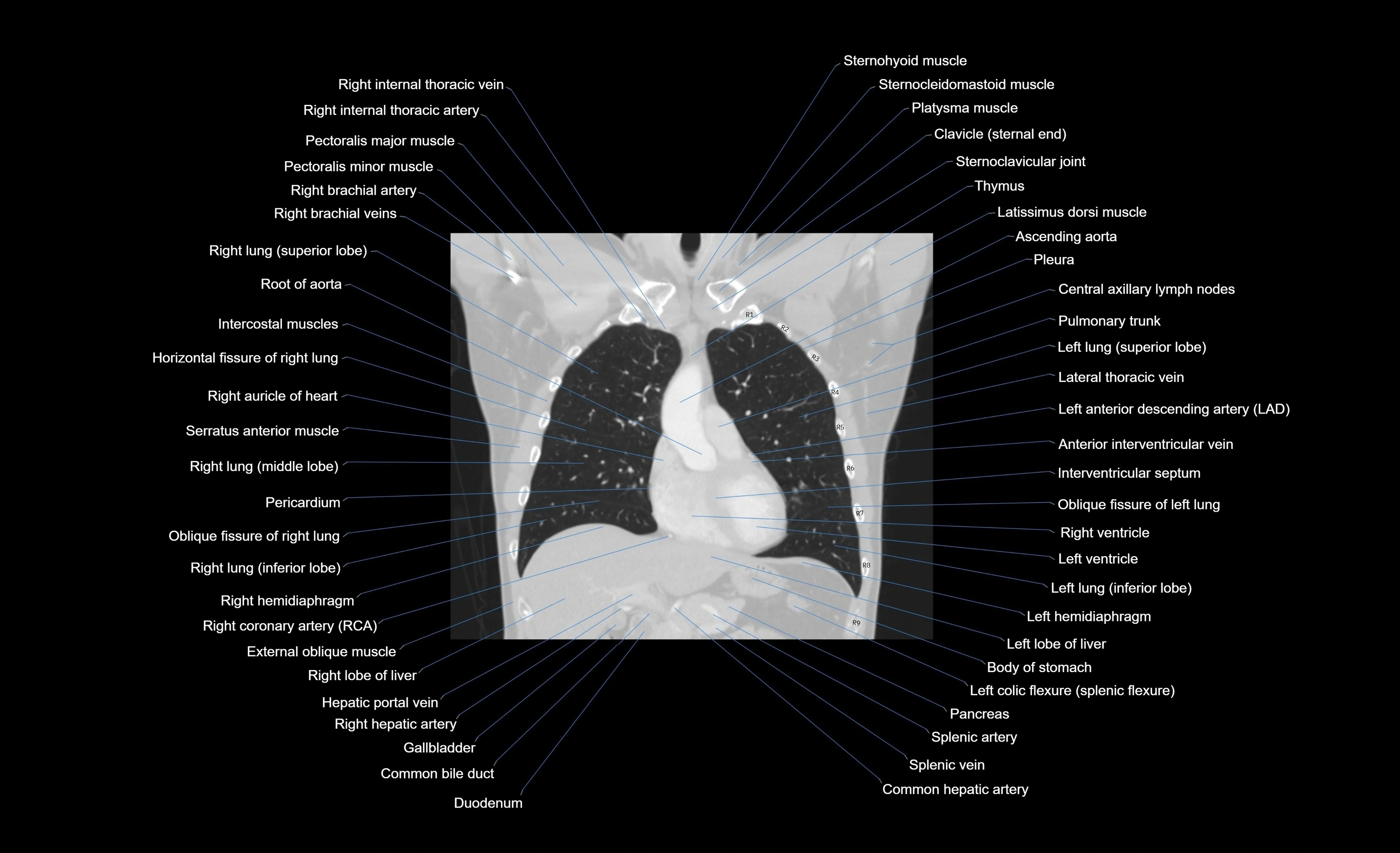 CT chest (thorax) labelled coronal cross sectional anatomy radiology image-00078.webp
